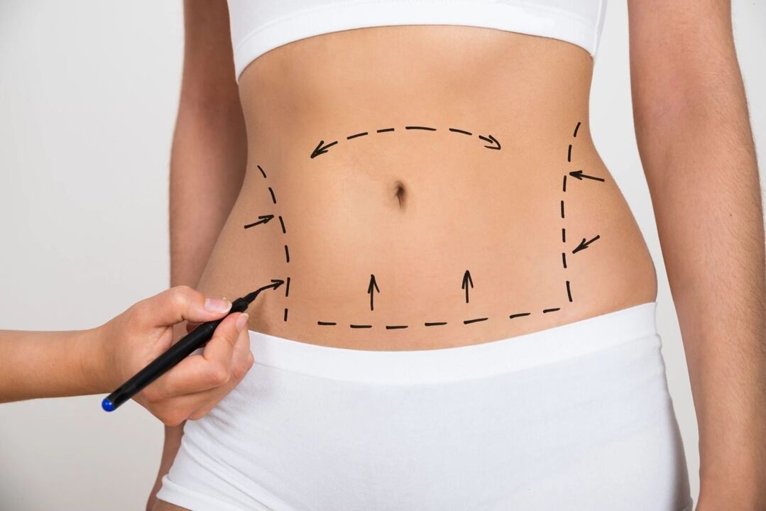 Marked on the abdomen before liposuction, correcting the figure